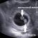 اگر سونوگرافی حاملگی را نشان نداد اما آزمایش مثبت بود چه باید کرد؟